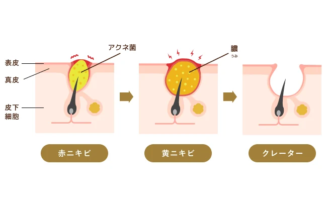 ニキビ跡・クレーターができる原因の図解