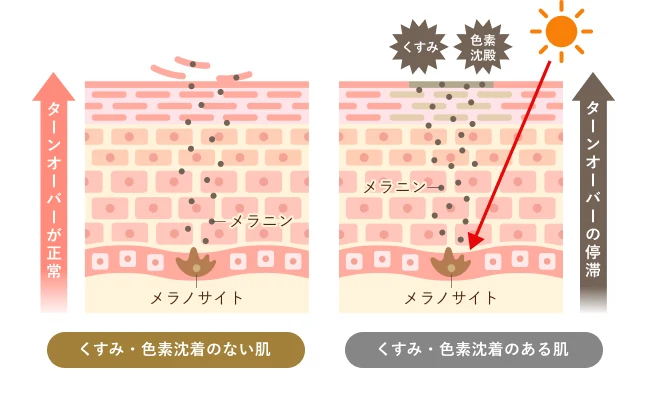 くすみ・色素沈着ができる原因の図解