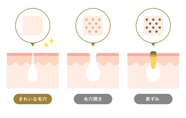 毛穴の開き・黒ずみができる原因の図解