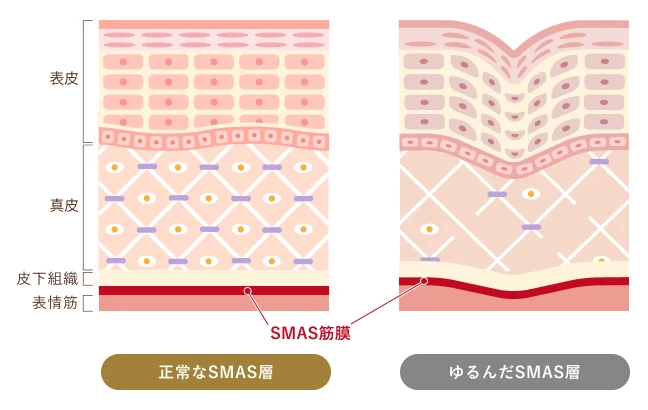 たるみができる原因の図解