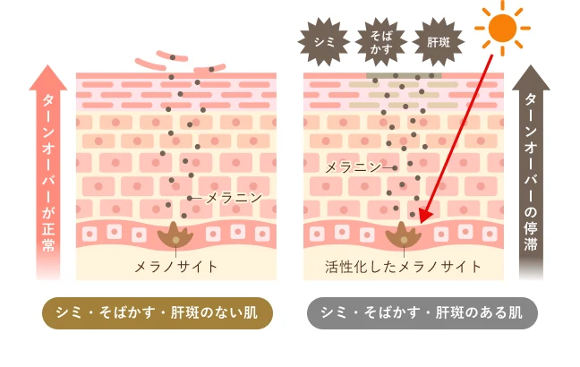 シミ・そばかす・肝斑ができる原因の図解